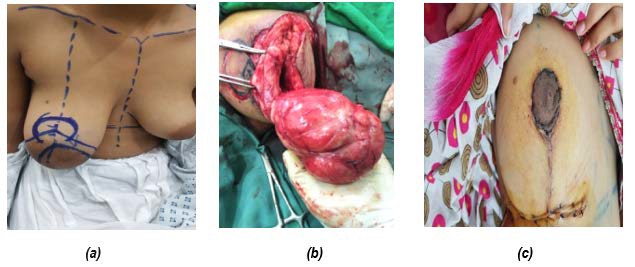 Increased asymmetry with larger breast size following the oncoplastic  parallelogram mastopexy lumpectomy for cancer - Chen - 2021 - The Breast  Journal - Wiley Online Library