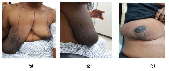 Showing marked breast asymmetry with a huge right breast mass and