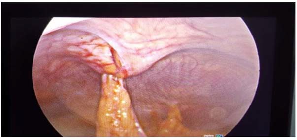 Figure 1 from Single-Port Repair of Diastasis Recti and Umbilical