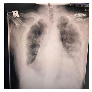 A x-ray of a chest

Description automatically generated with low confidence