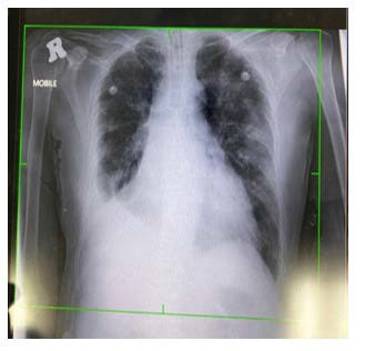 A x-ray of a chest

Description automatically generated with low confidence