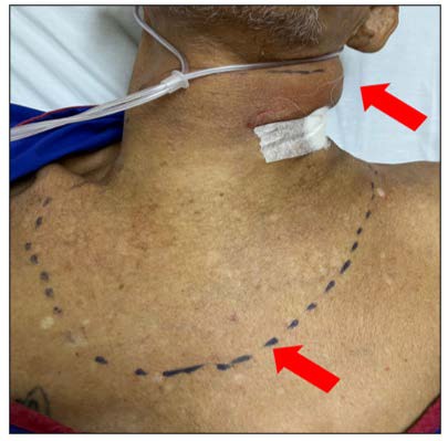 A person's neck with a line drawn on it

Description automatically generated