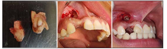 Close-up of teeth and gums

Description automatically generated