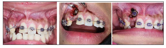 Close up of a person with braces

Description automatically generated