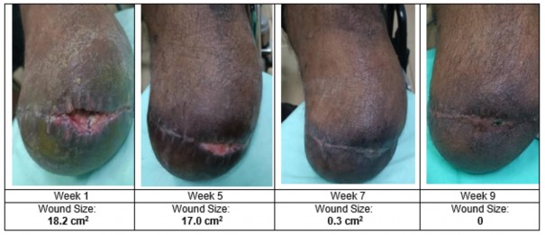 A close up of a wound

AI-generated content may be incorrect.