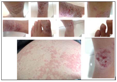 Close-up of skin rashes and skin rashes

AI-generated content may be incorrect.