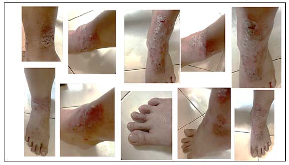 Close-up of a person's foot with a rash

AI-generated content may be incorrect.