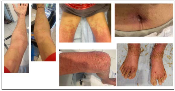 Several pictures of skin rashes

AI-generated content may be incorrect.