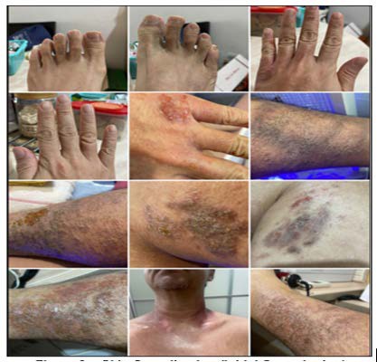 A collage of different skin diseases

AI-generated content may be incorrect.
